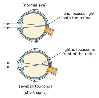 Eyeball illustration demonstrating short sight